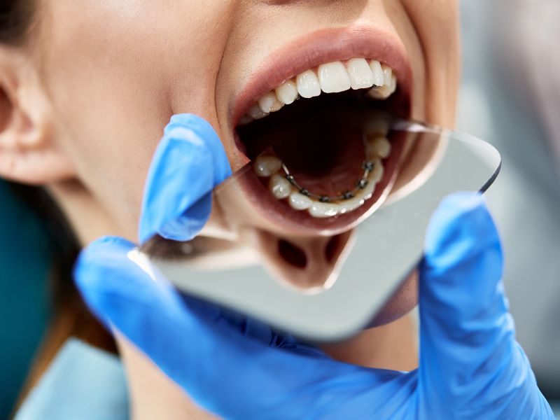 _Lingual Braces (6)