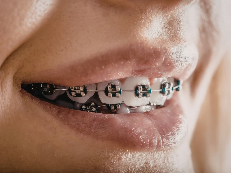 Traditional Metal Braces (1)