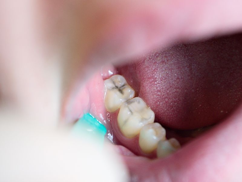 gum grafting