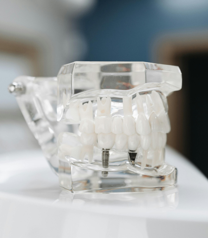 mini implant (1)