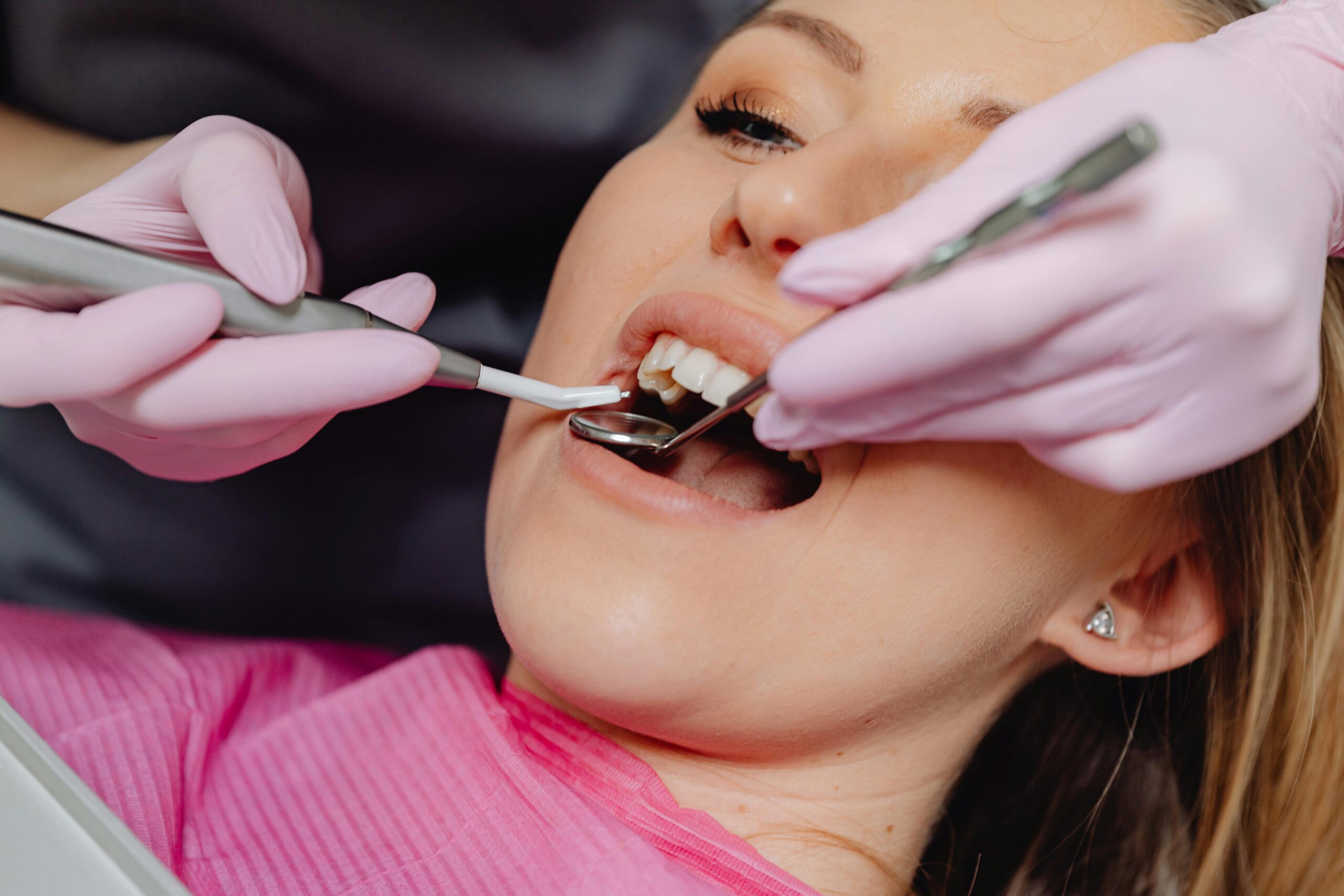 White Fillings vs Silver Amalgam Fillings